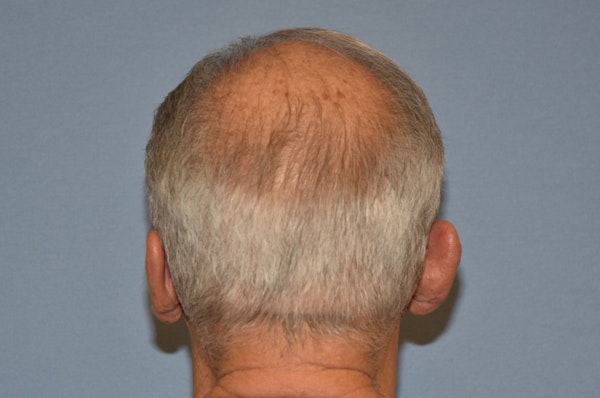 Otoplasty Before & After Gallery - Patient 132611 - Image 3