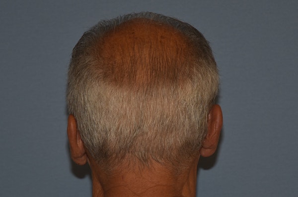 Otoplasty Before & After Gallery - Patient 132611 - Image 4