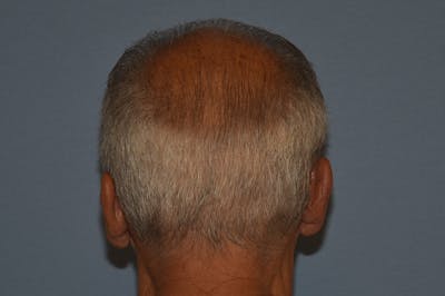Otoplasty Before & After Gallery - Patient 132611 - Image 4