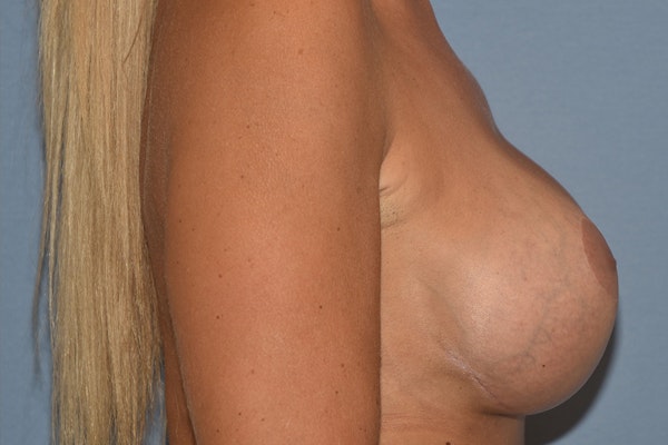 Breast Revision Before & After Gallery - Patient 388028 - Image 6