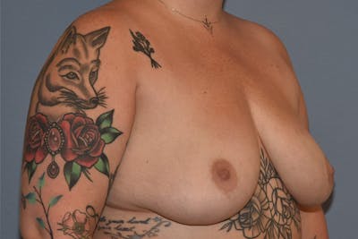Breast Implant Removal Before & After Gallery - Patient 160225 - Image 4