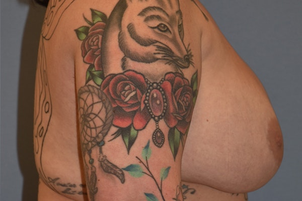 Breast Implant Removal Before & After Gallery - Patient 160225 - Image 5