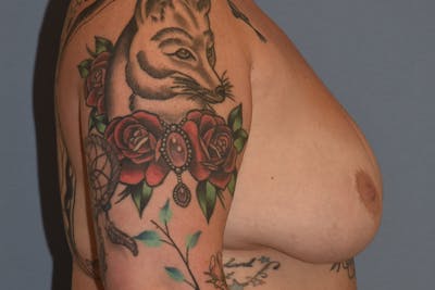 Breast Implant Removal Before & After Gallery - Patient 160225 - Image 6