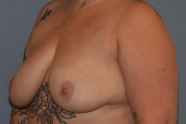 Breast Implant Removal Before & After Gallery - Patient 160225 - Image 8