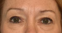 Eyelid Lift Before & After Gallery - Patient 105479 - Image 1