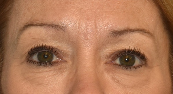 Eyelid Lift Before & After Gallery - Patient 105479 - Image 1