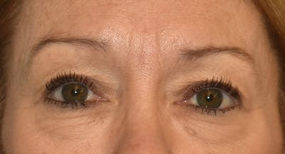 Eyelid Lift Before & After Gallery - Patient 105479 - Image 1
