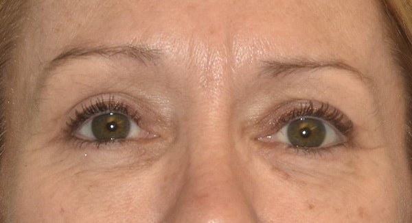 Eyelid Lift Before & After Gallery - Patient 105479 - Image 2