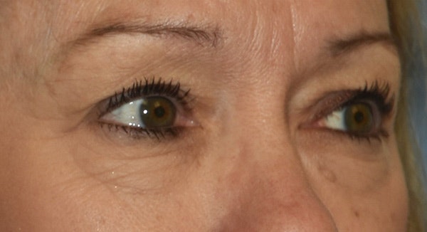 Eyelid Lift Before & After Gallery - Patient 105479 - Image 3
