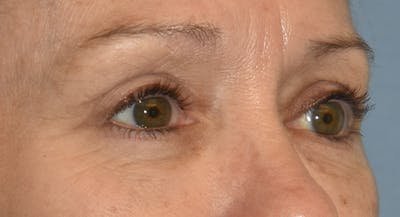 Eyelid Lift Before & After Gallery - Patient 105479 - Image 4