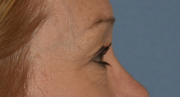 Eyelid Lift Before & After Gallery - Patient 105479 - Image 5