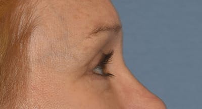 Eyelid Lift Before & After Gallery - Patient 105479 - Image 6