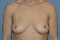 Breast Augmentation Before & After Gallery - Patient 336833 - Image 1