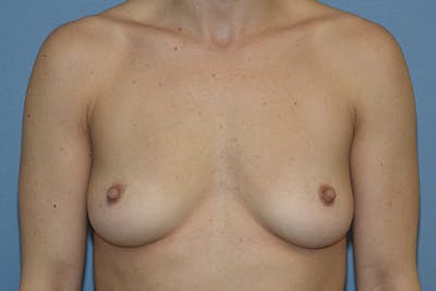 Breast Augmentation Before & After Gallery - Patient 336833 - Image 1
