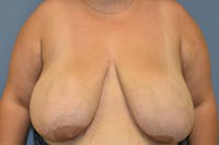 Breast Reduction Before & After Gallery - Patient 337207 - Image 1