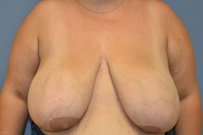 Breast Reduction Before & After Gallery - Patient 337207 - Image 1