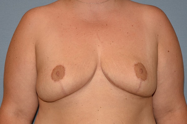 Breast Reduction Before & After Gallery - Patient 337207 - Image 2