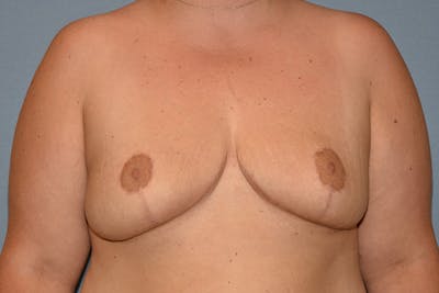Breast Reduction Before & After Gallery - Patient 337207 - Image 2