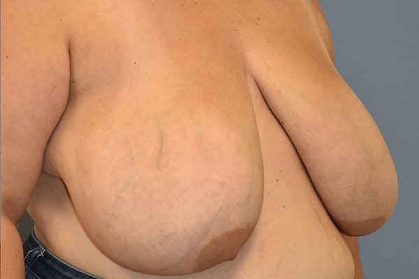Breast Reduction Before & After Gallery - Patient 337207 - Image 3