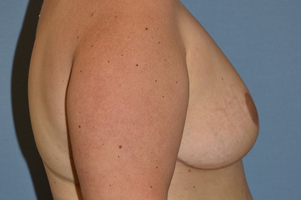 Breast Reduction Before & After Gallery - Patient 337207 - Image 6