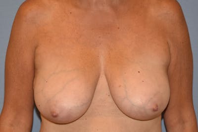 Breast Reduction Before & After Gallery - Patient 285853 - Image 1