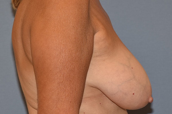 Breast Reduction Before & After Gallery - Patient 285853 - Image 5