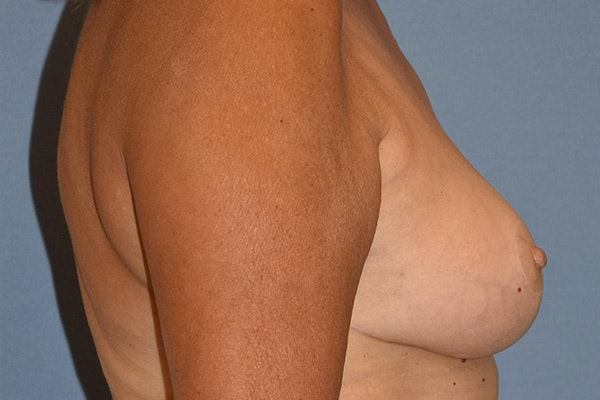 Breast Reduction Before & After Gallery - Patient 285853 - Image 6