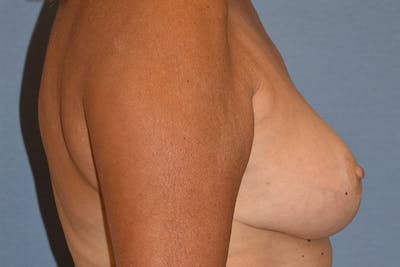 Breast Reduction Before & After Gallery - Patient 285853 - Image 6