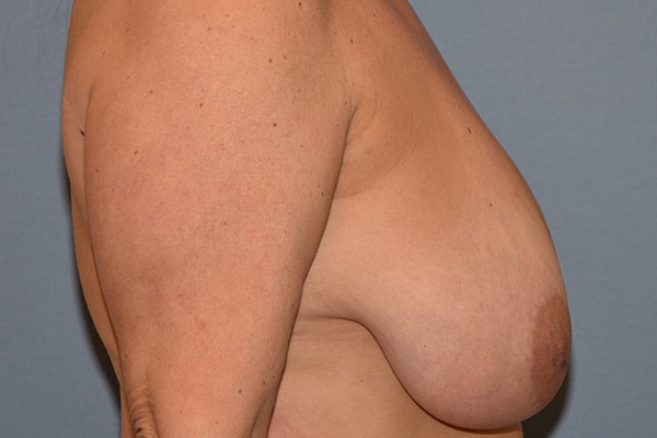Breast Reduction Before & After Gallery - Patient 450598 - Image 5