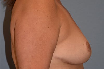 Breast Reduction Before & After Gallery - Patient 450598 - Image 6