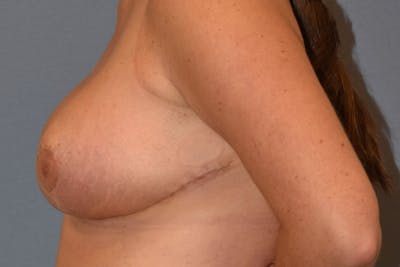 Breast Reduction Before & After Gallery - Patient 398983 - Image 6