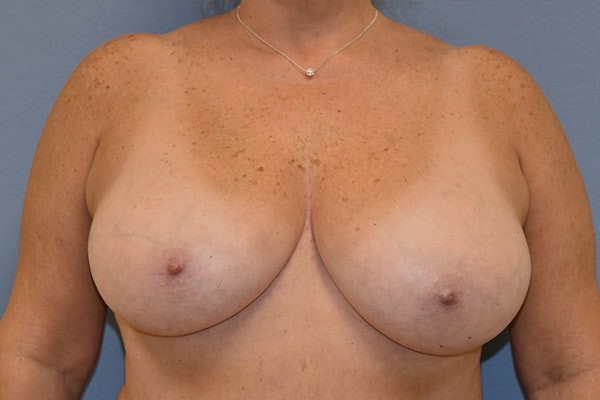 Breast Reduction Before & After Gallery - Patient 292427 - Image 1
