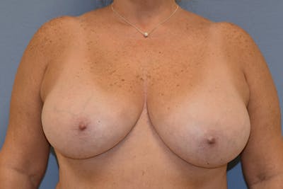 Breast Reduction Before & After Gallery - Patient 292427 - Image 1
