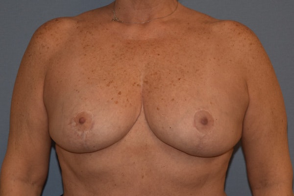 Breast Reduction Before & After Gallery - Patient 292427 - Image 2