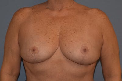 Breast Reduction Before & After Gallery - Patient 292427 - Image 2