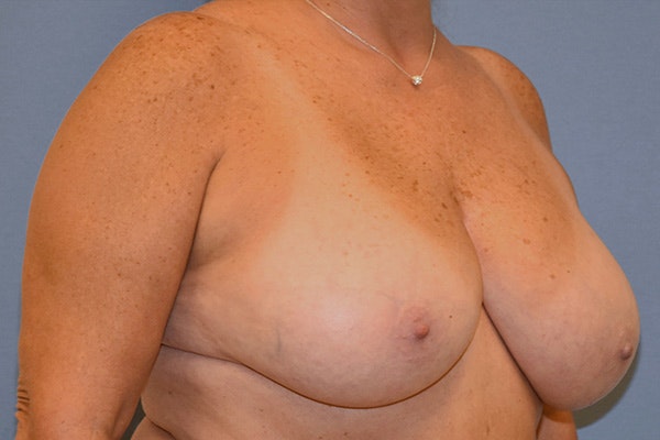 Breast Reduction Before & After Gallery - Patient 292427 - Image 3