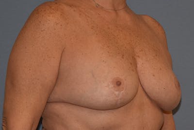 Breast Reduction Before & After Gallery - Patient 292427 - Image 4