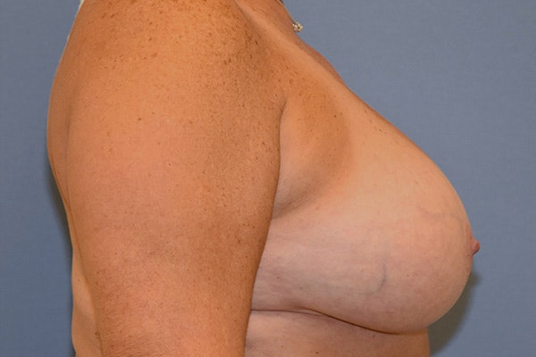 Breast Reduction Before & After Gallery - Patient 292427 - Image 5