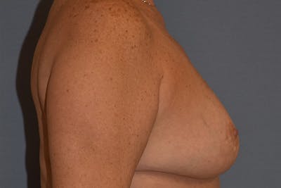 Breast Reduction Before & After Gallery - Patient 292427 - Image 6