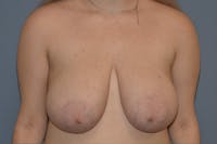 Breast Reduction Before & After Gallery - Patient 285720 - Image 1