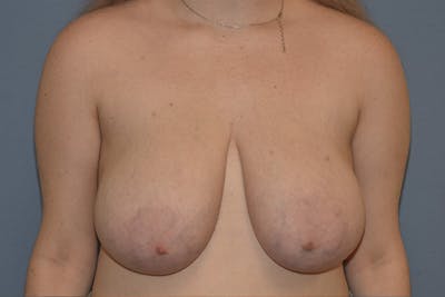 Breast Reduction Before & After Gallery - Patient 285720 - Image 1