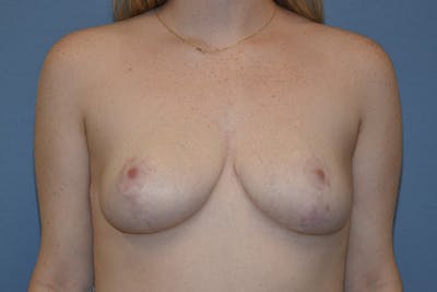Breast Reduction Before & After Gallery - Patient 285720 - Image 2