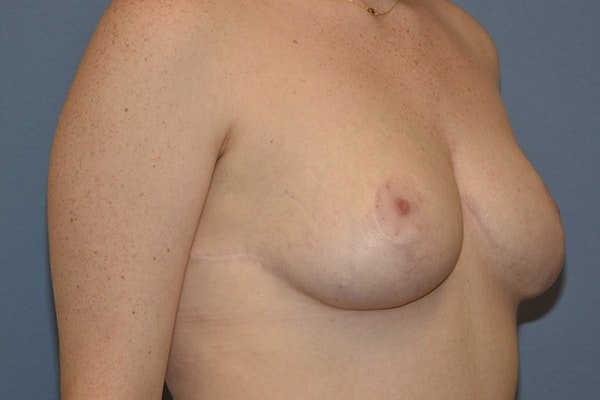 Breast Reduction Before & After Gallery - Patient 285720 - Image 4