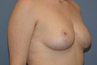 Breast Reduction Before & After Gallery - Patient 285720 - Image 4
