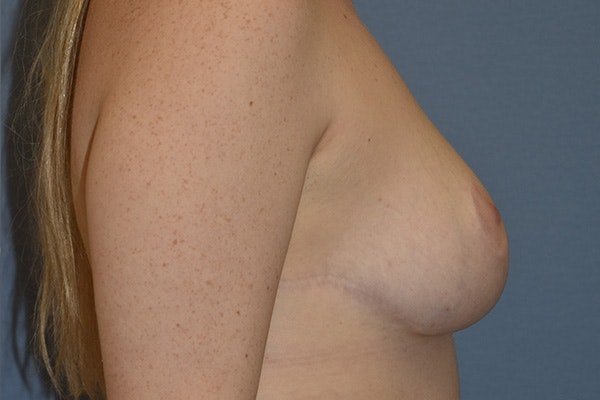 Breast Reduction Before & After Gallery - Patient 285720 - Image 6
