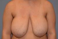 Breast Reduction Before & After Gallery - Patient 350722 - Image 1