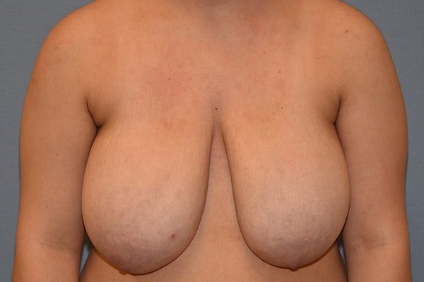 Breast Reduction Before & After Gallery - Patient 350722 - Image 1