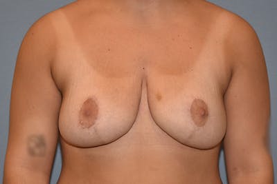 Breast Reduction Before & After Gallery - Patient 350722 - Image 2