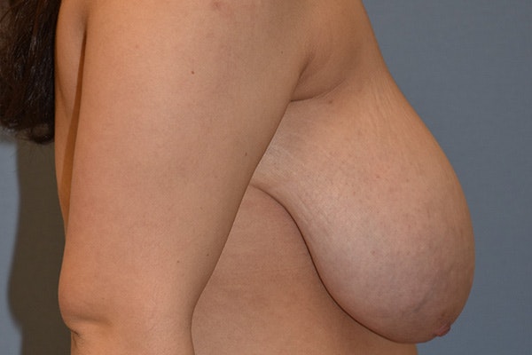 Breast Reduction Before & After Gallery - Patient 350722 - Image 5