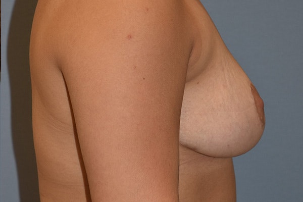 Breast Reduction Before & After Gallery - Patient 350722 - Image 6